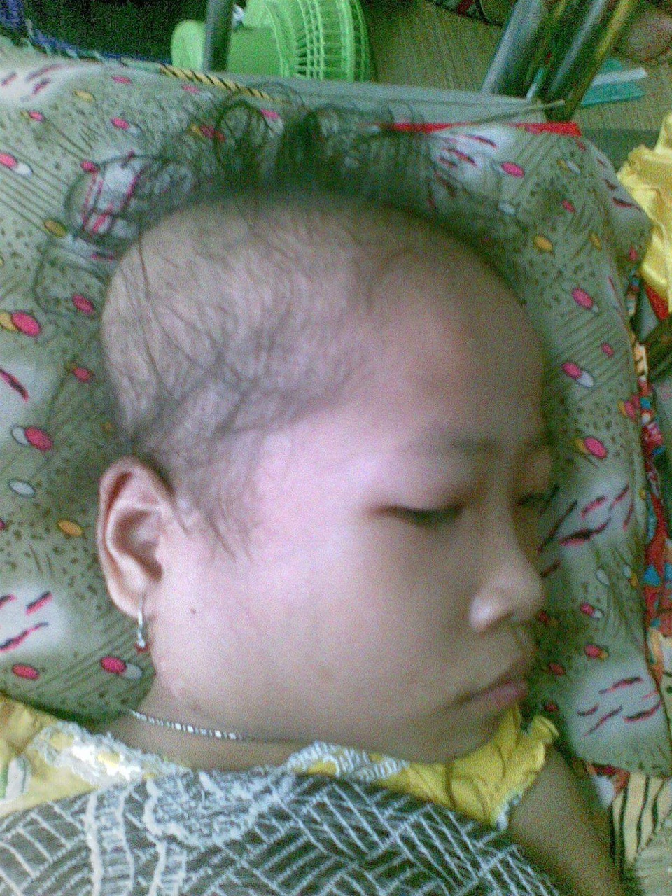 Nhà nghèo, cha bệnh, bé gái bị ung thư vật vờ chờ chết - 3 Khi đánh thuốc vào, nó lại xẹp xuống