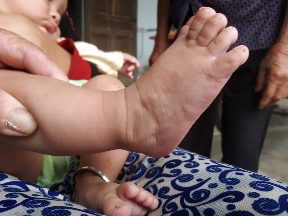 "Đừng khóc nữa, con ơi !..." - 5 Bàn chân phải bé Duy sau nhều năm nấn ép, điều chỉnh xương...