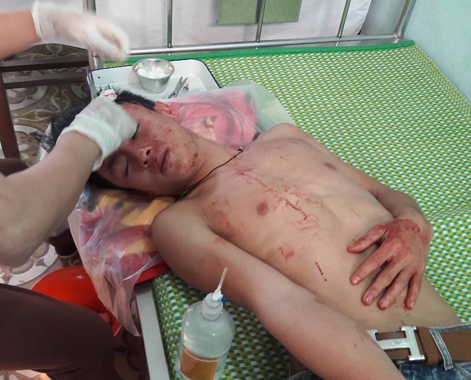 Nhóm thanh niên vào trường học gây rối, đánh thầy giáo, học sinh nhập viện - 2 Em Tài bị đánh và khâu 10 mũi trên đầu.