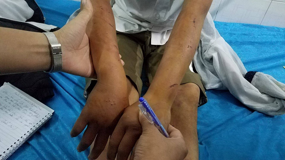 Cậu bé 11 tuổi nghi bị bố đánh đa chấn thương - 2 Bàn tay sưng vù vì bị đánh