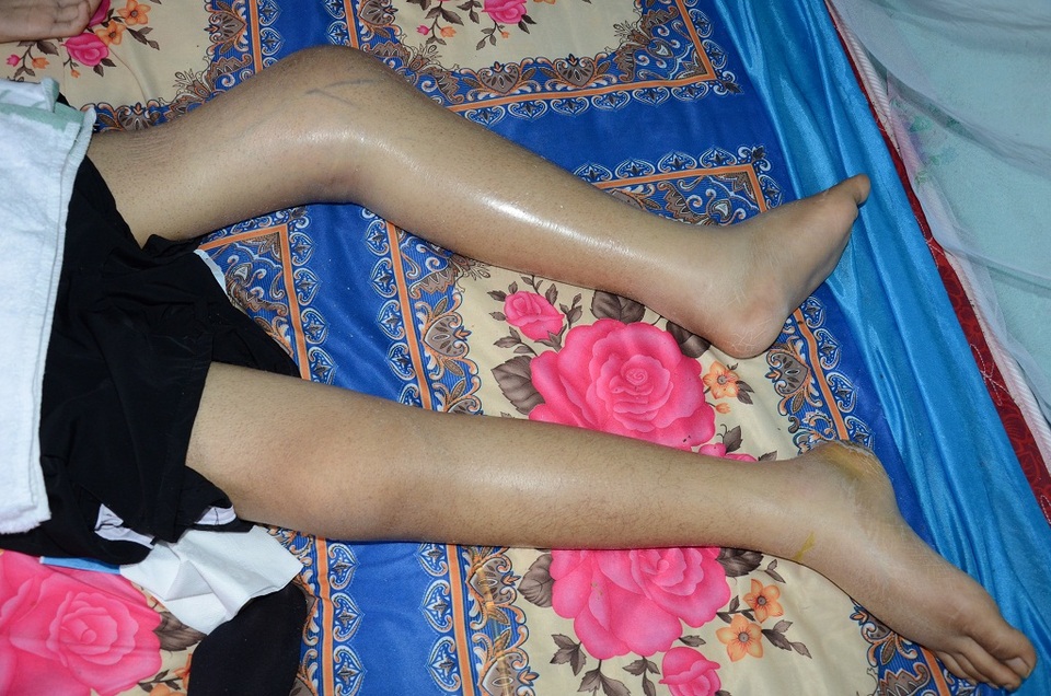 Tiếng kêu cứu ai oán của người mẹ nghèo xin được cắt chân cho con - 2
Căn bệnh ung thư xương khiến chân trái sung tấy, em không thể đi lại được.