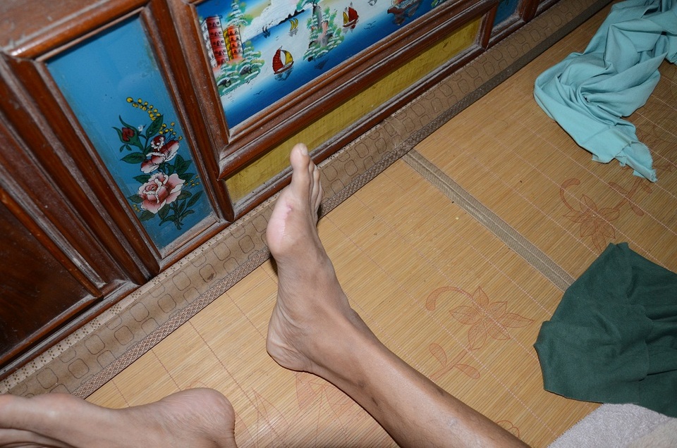 “Anh ơi, đừng bỏ mẹ con em... !” - 3
Một ngón chân cũng đã bị tháo bỏ