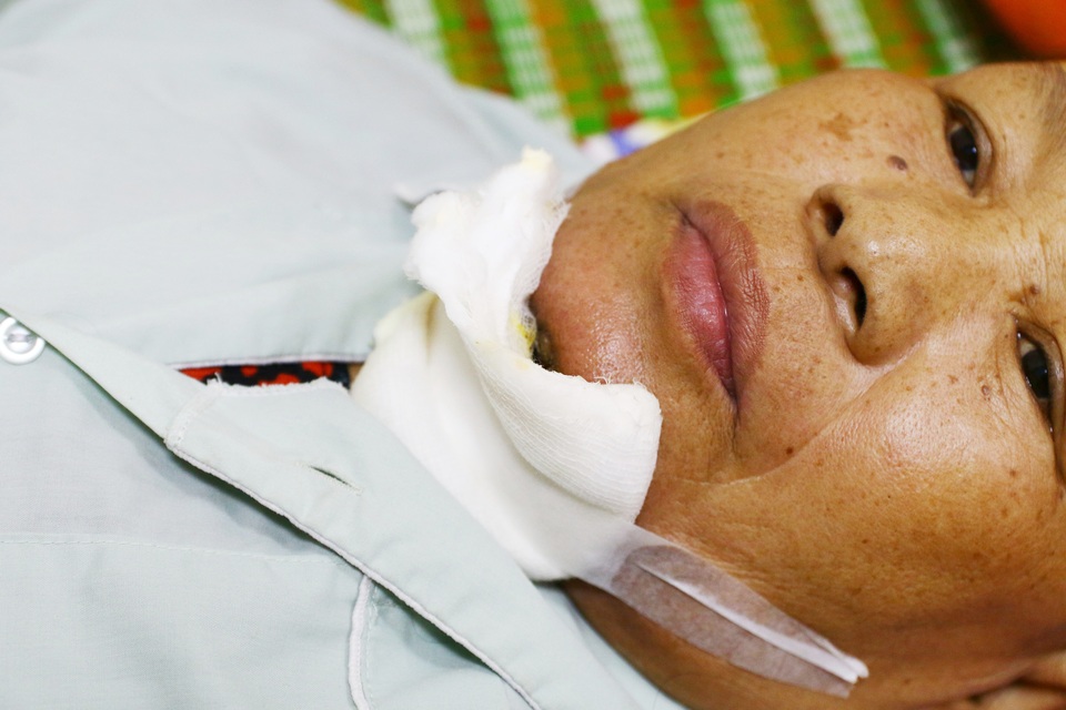 Cảm phục cảnh con rể chăm sóc mẹ bị ung thư bên giường bệnh - 4 Khối u sàn miệng và vết loét dưới cằm của dì Lợi