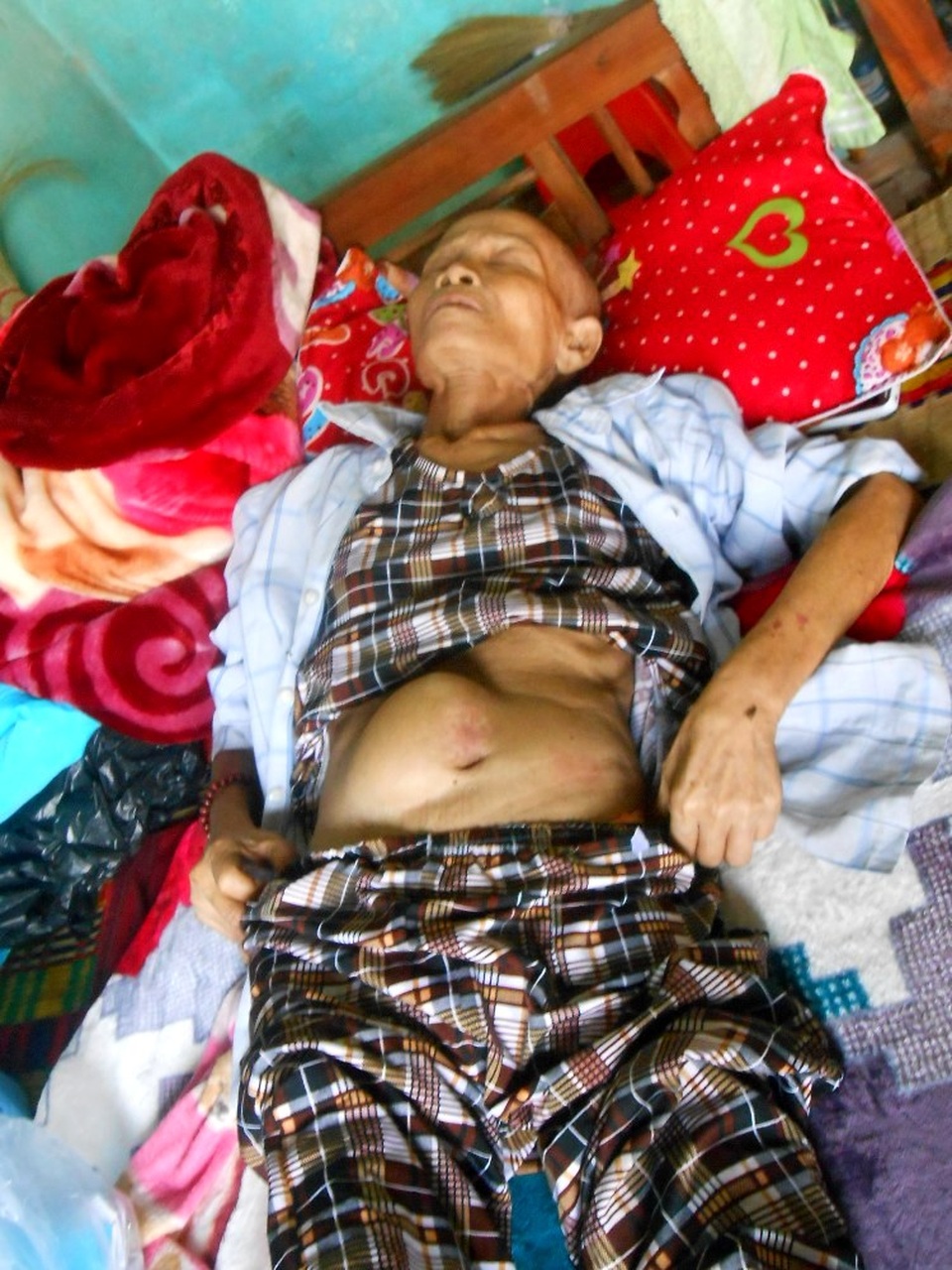 Xót xa cảnh mẹ già gồng gánh nuôi hai con bệnh tật - 5 Ung thư dạ dày nay đã di căn nặng