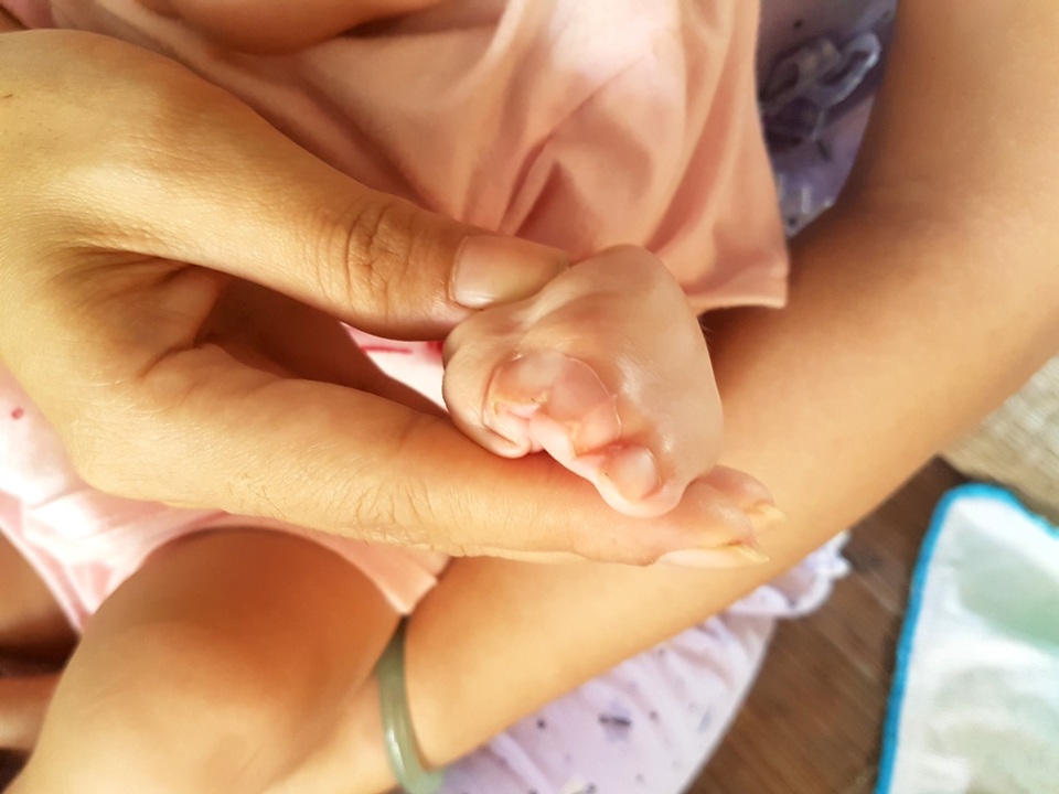 Thương bé 7 tháng tuổi mắc hội chứng Apert hiếm gặp - 5 Thương bé 7 tháng tuổi mắc hội chứng Apert hiếm gặp - 5