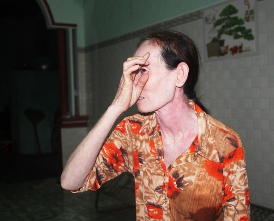 Bà Hoa (vợ ông Khương) chỉ tay vào vết khâu do mảnh gạch, bê tông bắn vào đầu phải khâu 5 mũi