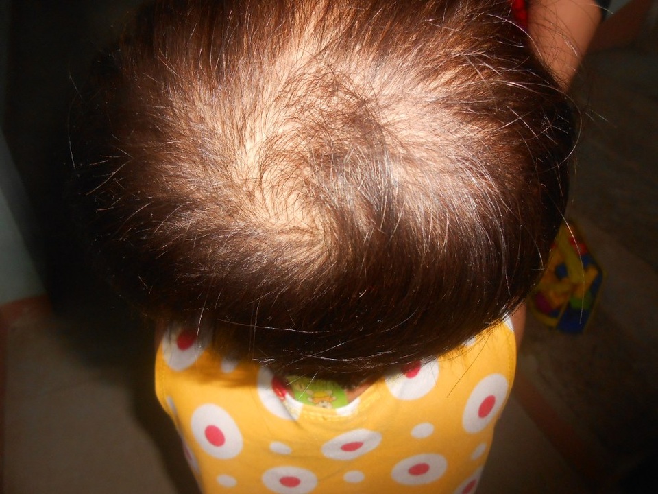 Thương bé 5 tuổi mang trên mình căn bệnh quái ác - 8 Từ mái tóc dài nay đã rụng nhiều do bệnh tật