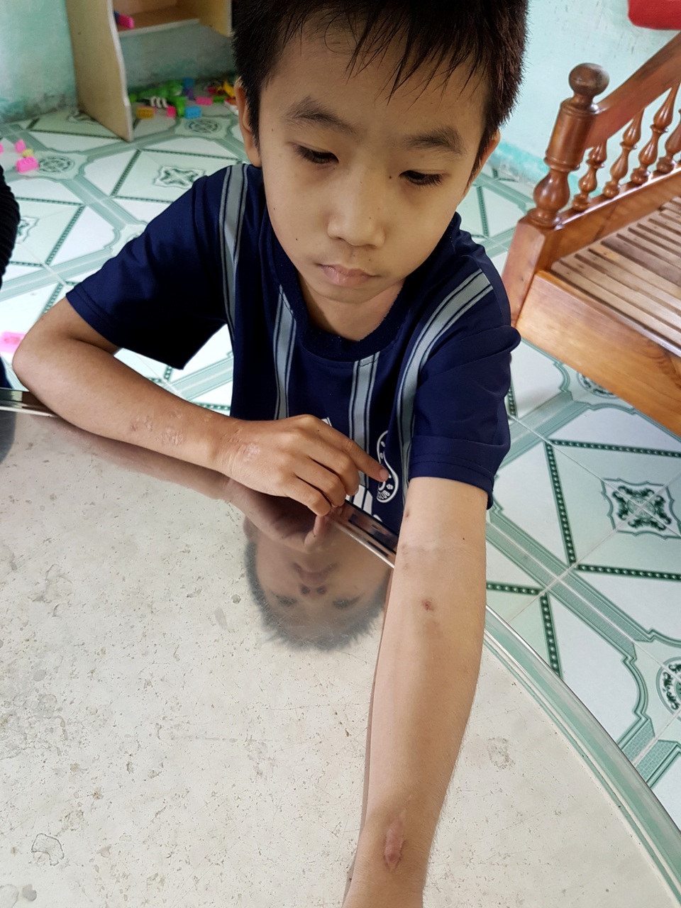 Vết kim chạy thận trên tay của Bảo. Chị Phúc cho biết, vì cháu nhỏ nên mỗi lần chạy thận phải tìm ven rất khó khăn