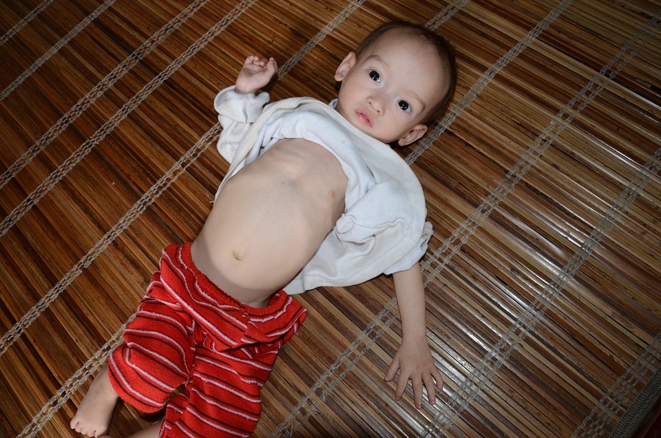 Gia cảnh khốn cùng của bé 14 tháng tuổi chỉ nặng có 4,5kg - 1
Bé Thư 14 tháng tuổi,bị hen suyễn lại suy dinh dưỡng nên bé chỉ nặng có 4,5 cân