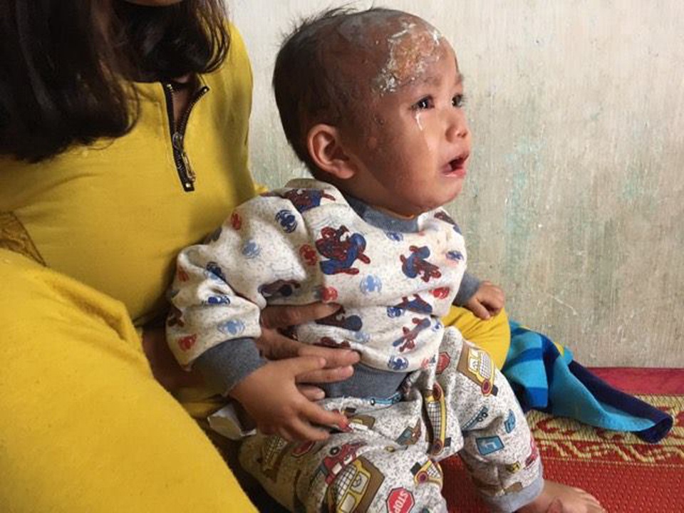 Xót xa bé 17 tháng bỏng nửa khuôn mặt do nước sôi - 1 Cháu Sơn đang được điều trị tại khoa Ngoại bệnh viện ĐK Thạch Hà