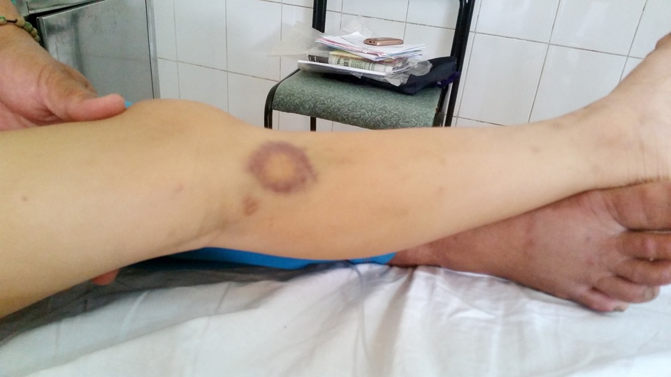 Ở chân cháu xuất hiện những vết bầm tím do thiếu tiểu cầu