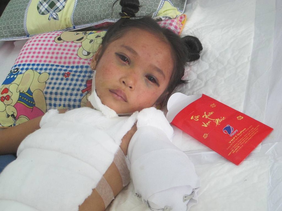 “Con nhớ tay con có 5 ngón, sao giờ không còn?” - 2 Cháu Minh phải cắt cụt cánh tay trái, theo dõi chấn thương gan, chấn thương ngực, chấn thương sọ não