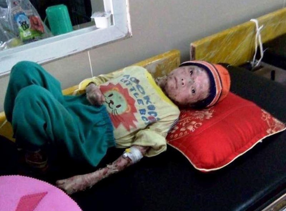 Toàn thân phủ "vỏ cây khô", chàng trai 17 tuổi chỉ nặng 9kg - 2 17 năm qua, Tài phải co ro sống trong đau đớn về thể xác lẫn tinh thần.