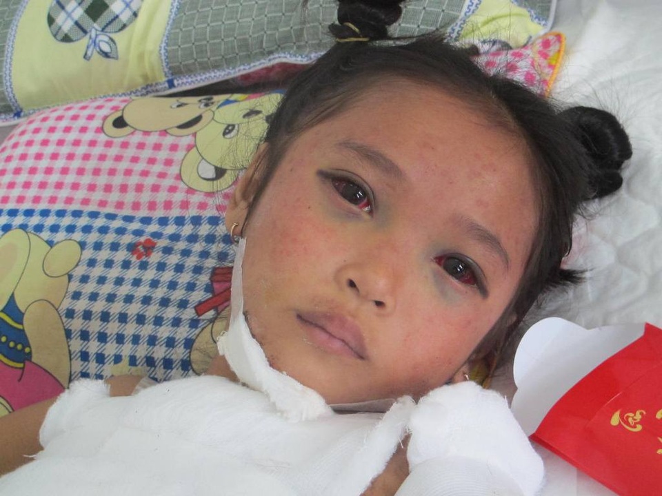“Con nhớ tay con có 5 ngón, sao giờ không còn?” - 4 Ánh mắt buồn của cô bé 8 tuổi khi vừa phải trải qua một cú sốc quá lớn