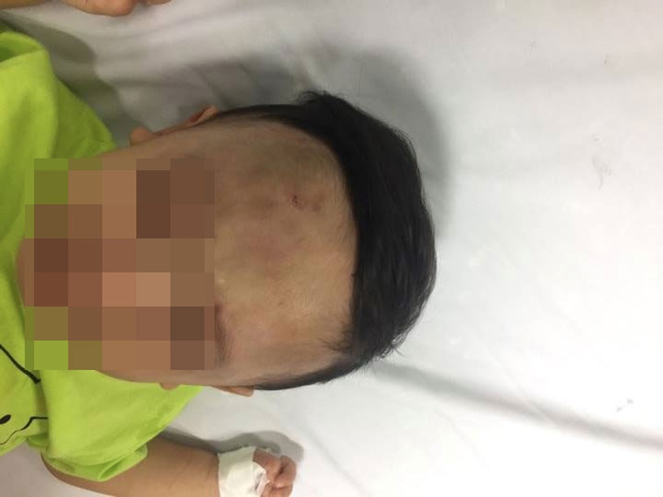 Hà Nội: Bé 1 tuổi bầm dập chân, đầu, vùng sinh dục nghi do bạo hành - 2
Toàn bộ vùng trán của cháu bé bầm tím