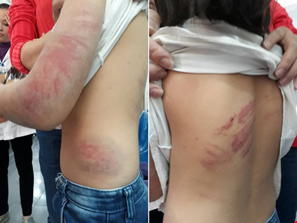 Bé gái lớp 4 bị bố đẻ đánh đập dã man - 1
Hình ảnh bé gái H. với nhiều vết thâm tím trên cơ thể được chia sẻ trên mạng xã hội Facebook, khiến cộng đồng mạng xót xa.