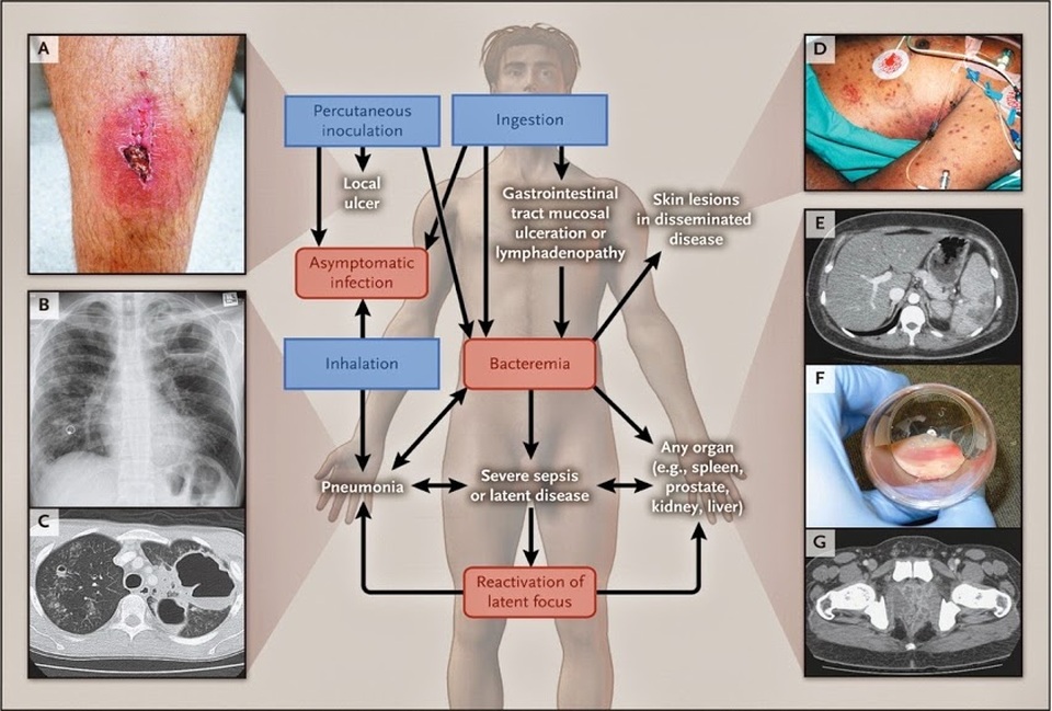 89.000 người chết trên thế giới do bệnh truyền nhiễm nguy hiểm Melioidosis - 3 Các biểu hiện lâm sàng sau khi nhiễm vi khuẩn B. pseudomallei (nguồn: Bệnh viện Bệnh Nhiệt đới Trung ương)
