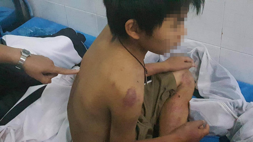 Cậu bé 11 tuổi nghi bị bố đánh đa chấn thương - 1
Cháu A. có nhiều vết thương trên cơ thể, nghi bị bố đánh.
