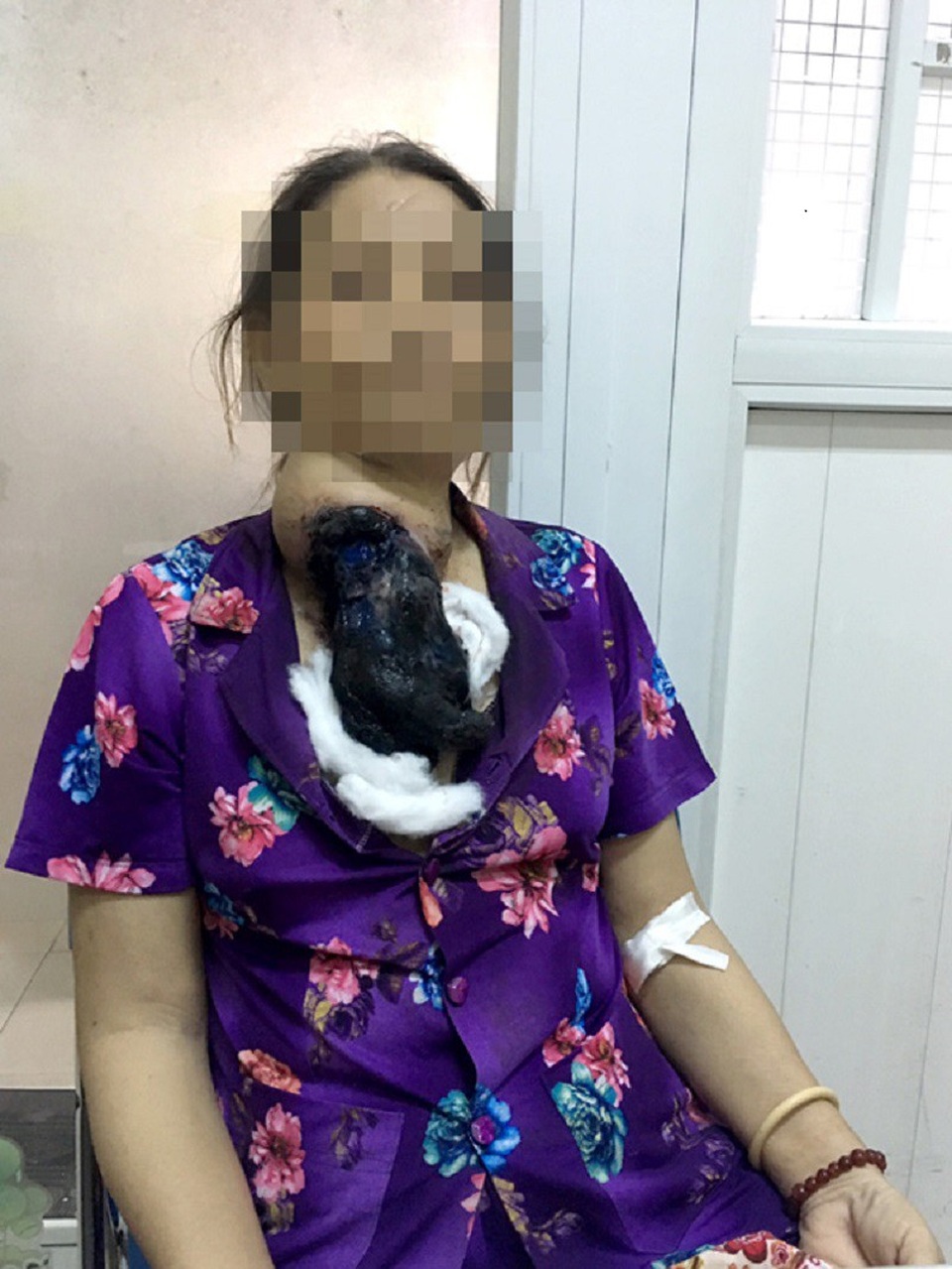 Thời điểm nhập viện, khối bướu của bệnh nhân hoại tử, bốc mùi hôi thối
