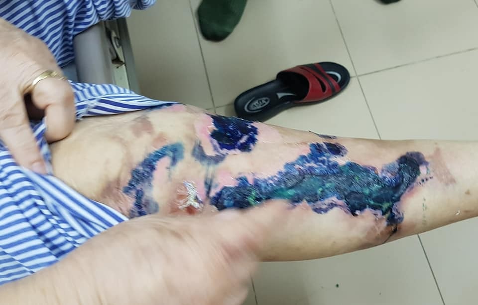 Gần 100% ca bỏng cồn do nướng mực, nướng cá - 2 Cồn bám vào quần áo, gây cháy khiến bệnh nhân bị bỏng. Ảnh: H.Hải