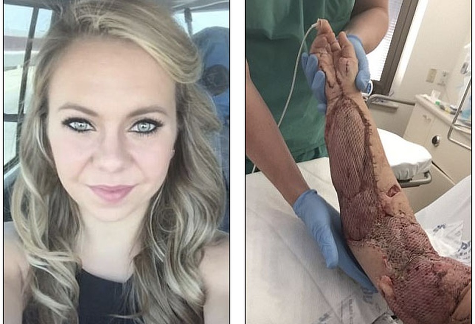 Kỳ diệu cánh tay nát bươm được hồi sinh - 2
Đã khiến cả cánh tay của cô gái xinh đẹp này dập nát gần như hoàn toàn