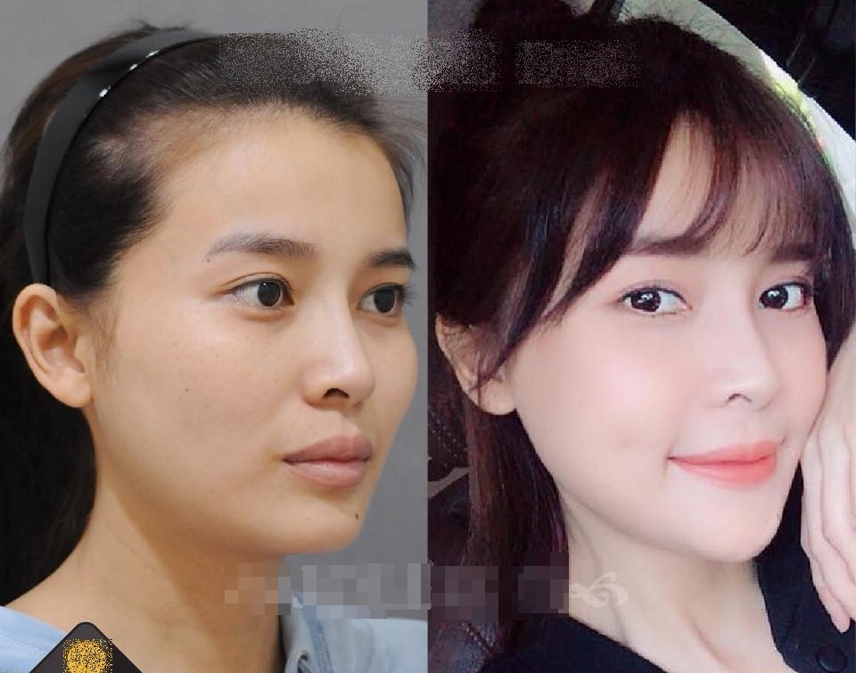 Cao Thái Hà thừa nhận ca “dao kéo” đau đớn, “có lỗi với ai đã yêu thương” - 4 Người đẹp công khai hình ảnh trước và sau chỉnh sửa nhan sắc.