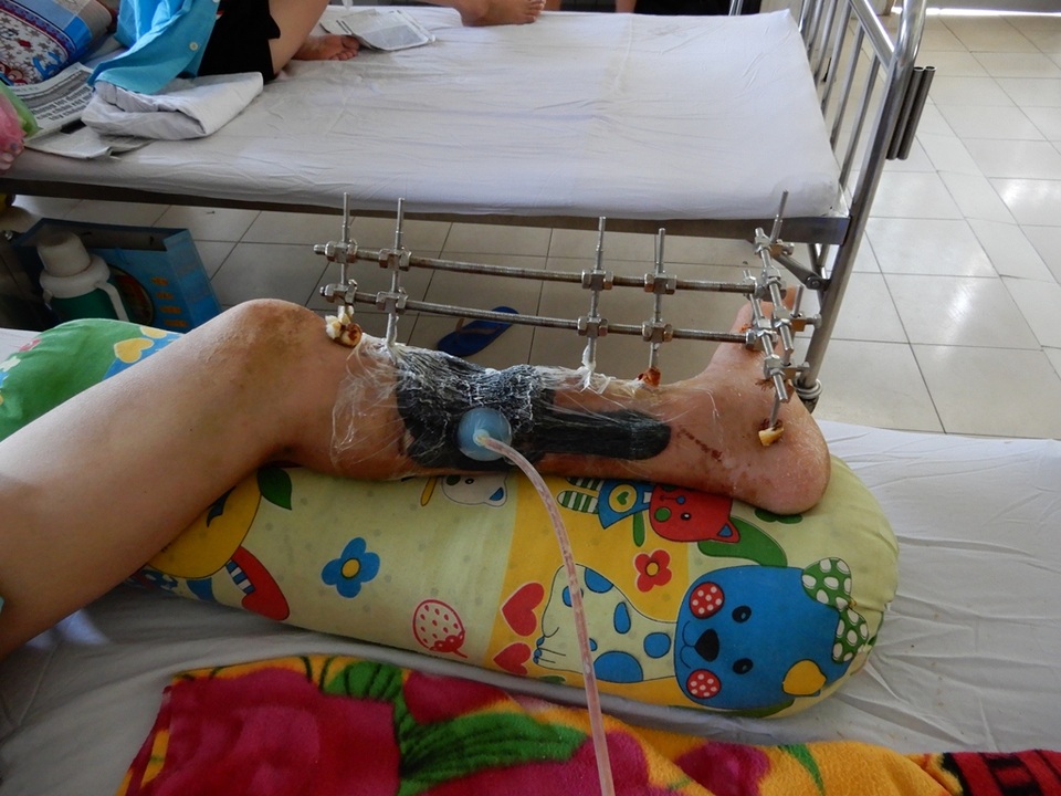 Bị tai nạn giao thông, bố và con gái 7 tuổi có nguy cơ mất chân - 3 Bị tai nạn giao thông, bố và con gái 7 tuổi có nguy cơ mất chân - 3