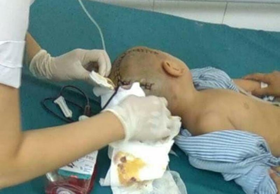 Bé 3 tuổi phải phẫu thuật vì bị chấn thương sọ não ở trường - 2 Cháu Bảo được phẫu thuật gấp do chấn thương sọ não, tụ máu não tại Bệnh viện (ảnh gia đình cung cấp)