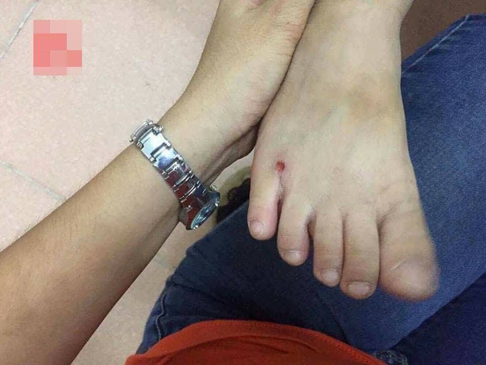 Vụ cô giáo đánh con riêng của chồng nhập viện: Hành trình tìm bằng chứng của mẹ đẻ - 1 Vết bầm trên chân cháu bé