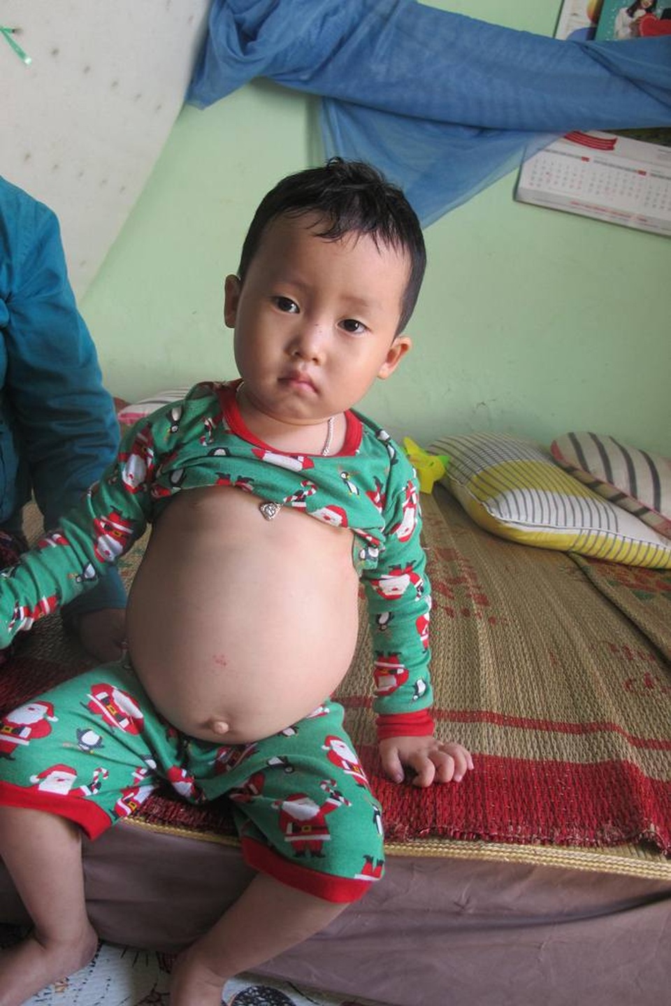 Mắc bệnh gan nặng, bé trai 4 tuổi bụng to như cái trống - 1 Cháu Mai Xuân Tiến bị bệnh gan đa nang, thận xốp hai bên