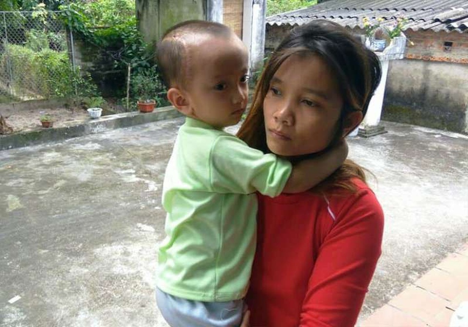 Bé 3 tuổi phải phẫu thuật vì bị chấn thương sọ não ở trường - 3 Ngày 10/10 cháu Bảo đã xuất viện sau khi được phẫu thuật, nhưng sức khỏe vẫn còn yếu