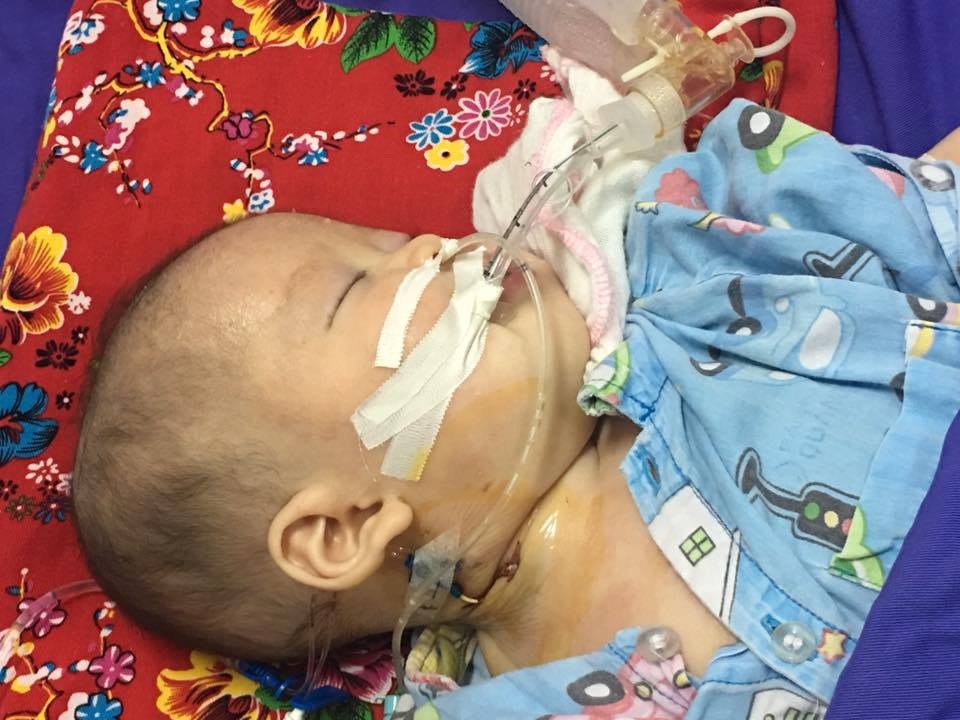 Bé hôn mê, thở máy vì mẹ cho dùng thuốc cam chữa viêm da cơ địa - 1 Bệnh nhi vẫn đang phải thở máy, điều trị thải độc chì. Ảnh: BS cung cấp.