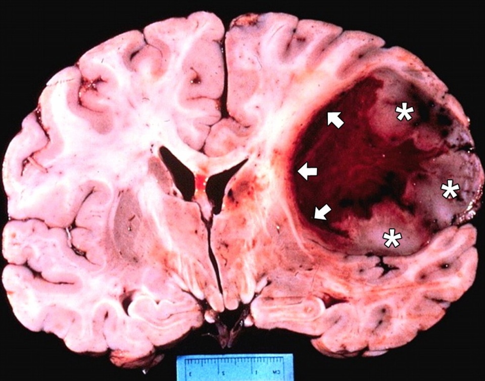 Các nhà khoa học Anh với tham vọng chữa ung thư não bằng… virus Zika - 2 Ung thư não Glioblastoma.