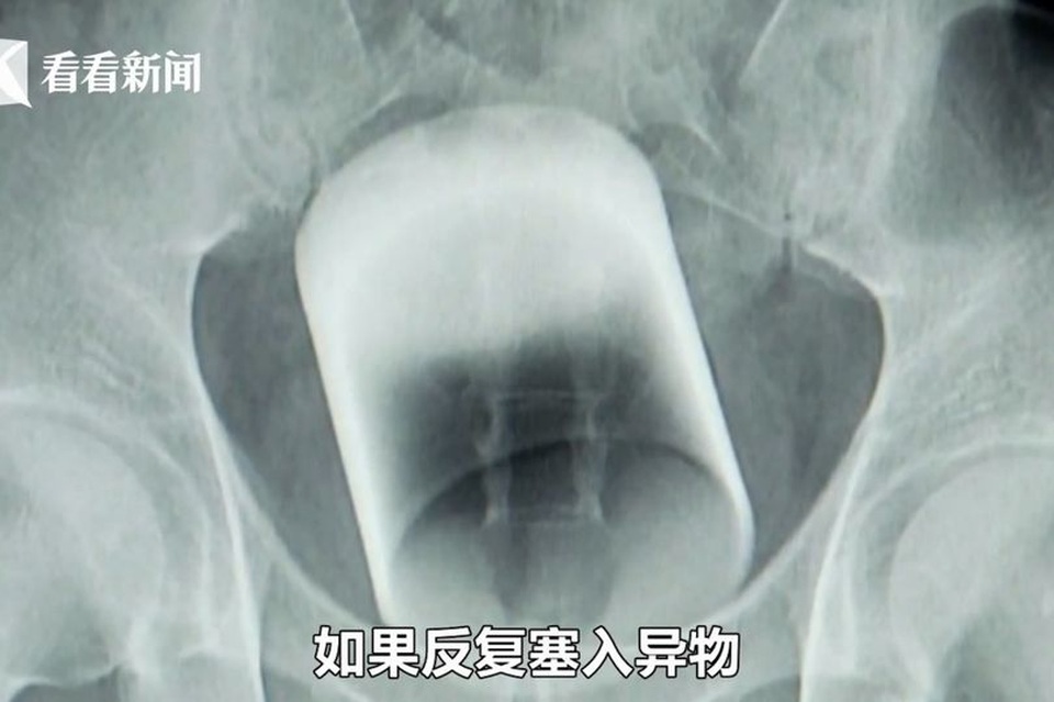 Giải cứu bệnh nhân bị kẹt chiếc cốc dài 8cm trong trực tràng - 1