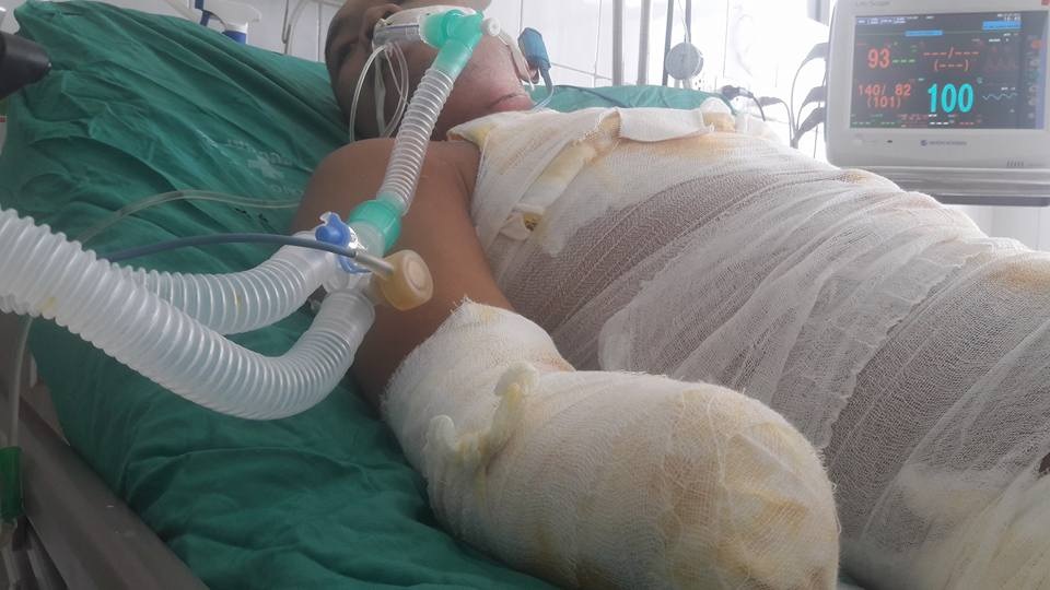Bị mất 2 tay vì điện cao thế phóng trúng người khi hàn tôn - 5
Cánh cửa tương lai tươi sáng bỗng chốc sập xuống khi đôi tay em đã không còn