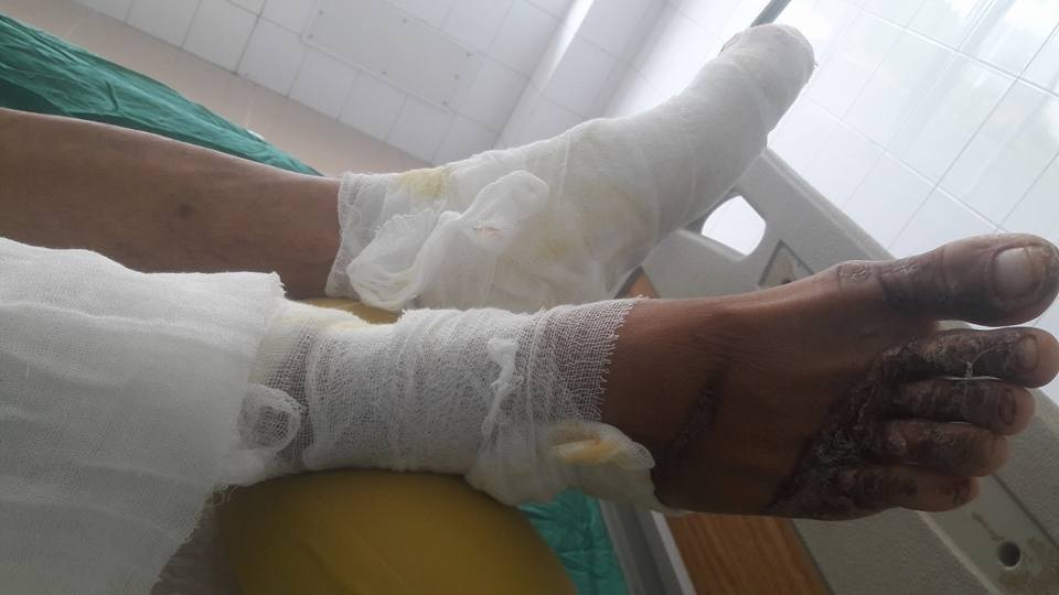 Bị mất 2 tay vì điện cao thế phóng trúng người khi hàn tôn - 2
Hiện tại vùng bụng, chân vẫn đang còn dấu hiệu hoại tử nặng phải điều trị kháng sinh liều cao