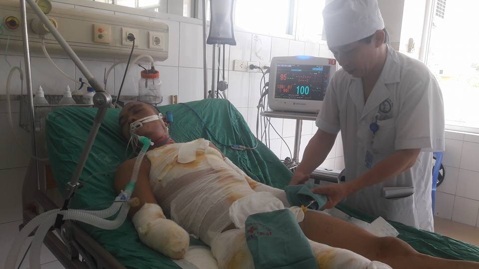 Bị mất 2 tay vì điện cao thế phóng trúng người khi hàn tôn - 3
Sau hơn nửa tháng cấp cứu, Nghĩa đã cai được máy thở nhưng tổn thương trên cơ thể vẫn còn 20%, đặc biệt ở sườn cơ và đùi phải