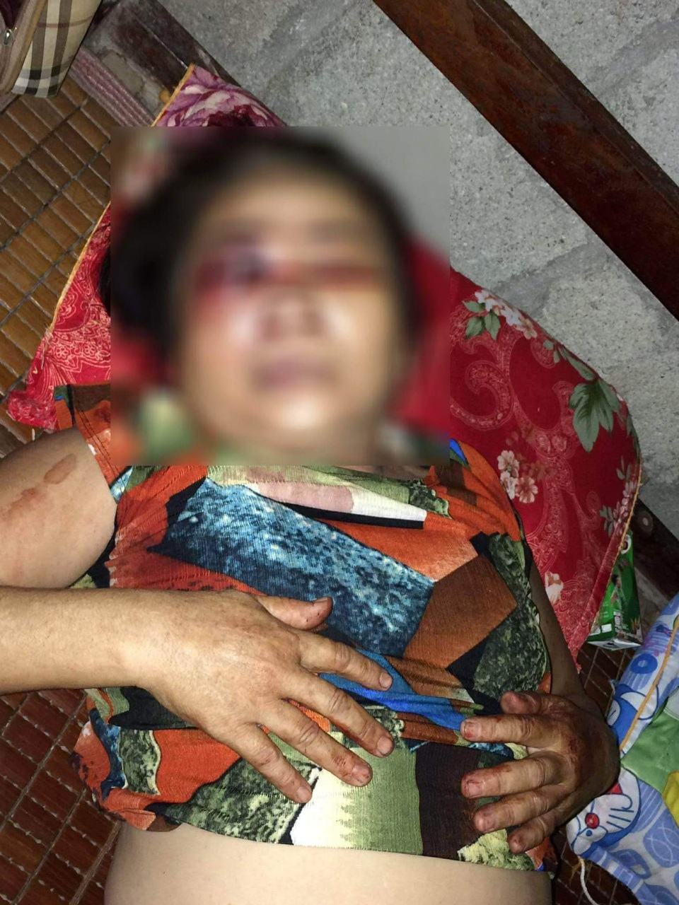 Truy tìm thanh niên đánh một phụ nữ 65 tuổi hư mắt - 1
Bà Y. đã bị đánh chấn thương nặng mắt phải