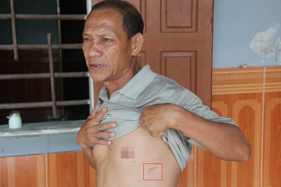 Cựu chiến binh hàng chục năm "ôm" mảnh đạn đi đòi chế độ thương binh - 1
Cựu binh Trần Văn Thái với vết thương trong trận tập kích vào trận địa pháo bảo vệ cầu Đông cách đây 45 năm.