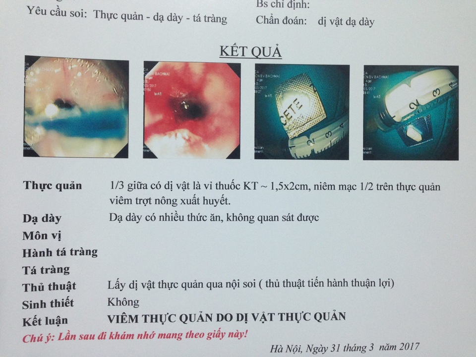 Hóc dị vật thực quản vì... uống thuốc - 1 Dị vật là viên thuốc còn nguyên vỏ được lấy ra khỏi thực quản bệnh nhân. Ảnh: BS cung cấp.