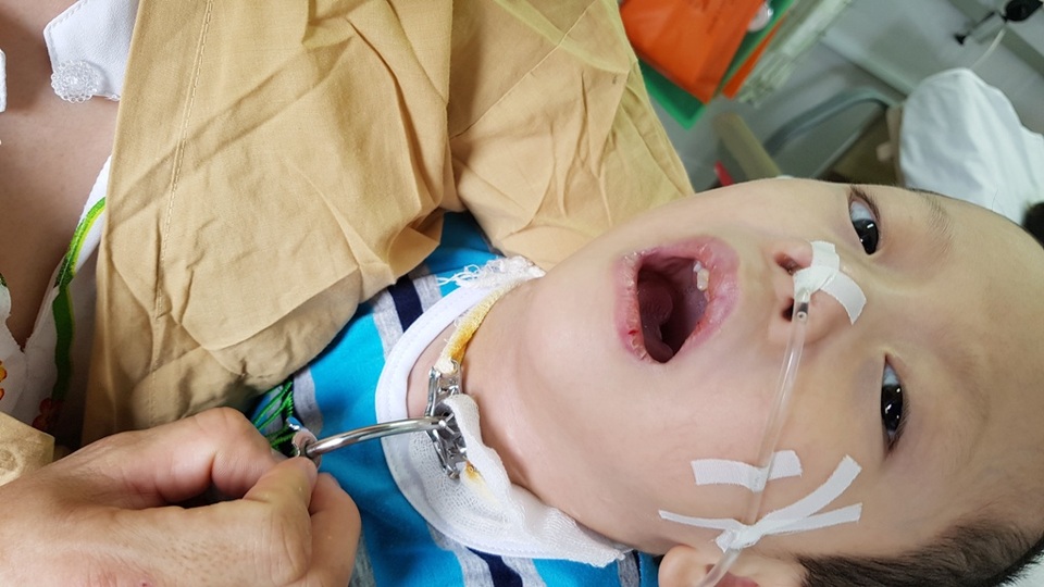 Trào nước mắt bé 4 tuổi bị biến chứng nặng sau khi mổ tim - 5 Cổ cháu phải đặt khai khí quản. Toàn bộ đường dẫn truyền dinh dưỡng từ thức ăn, thức uống, sữa vào cơ thể phải bơm