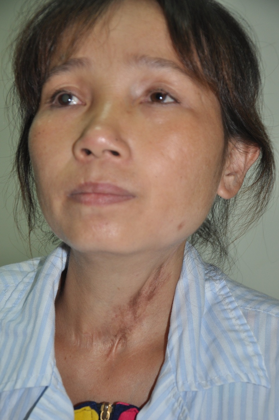 Đáng thương người mẹ "7 lần đẻ, 6 lần mất con" - 3 Ngoài căn bệnh đang mang, chị Như còn bị dò thực quản và đã phải mổ đi mổ lại hơn 10 lần.