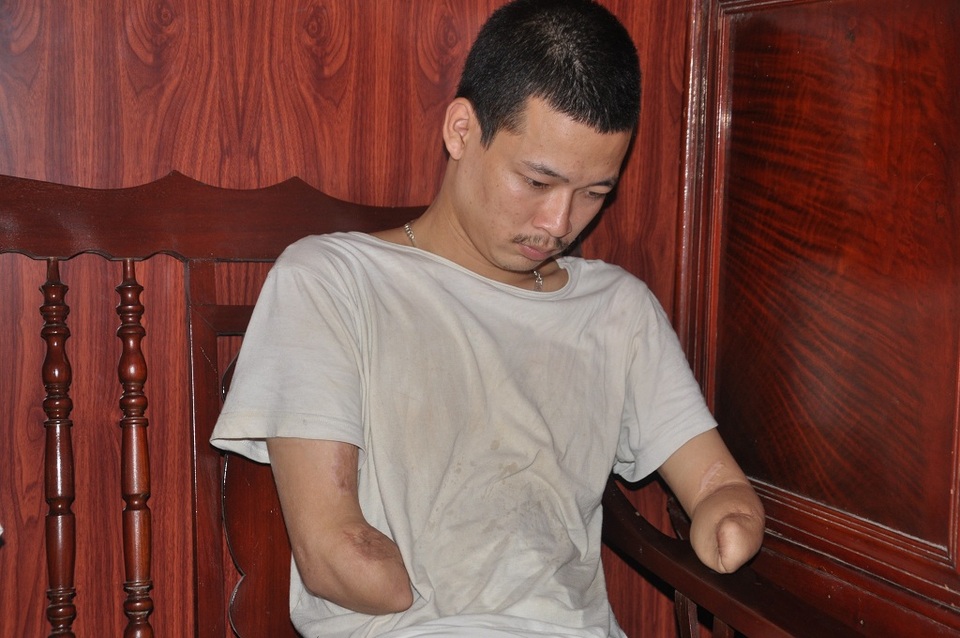 Bị điện cao thế giật mất hai cánh tay, Hùng còn bị gãy xương sống và chùn xương chậu.