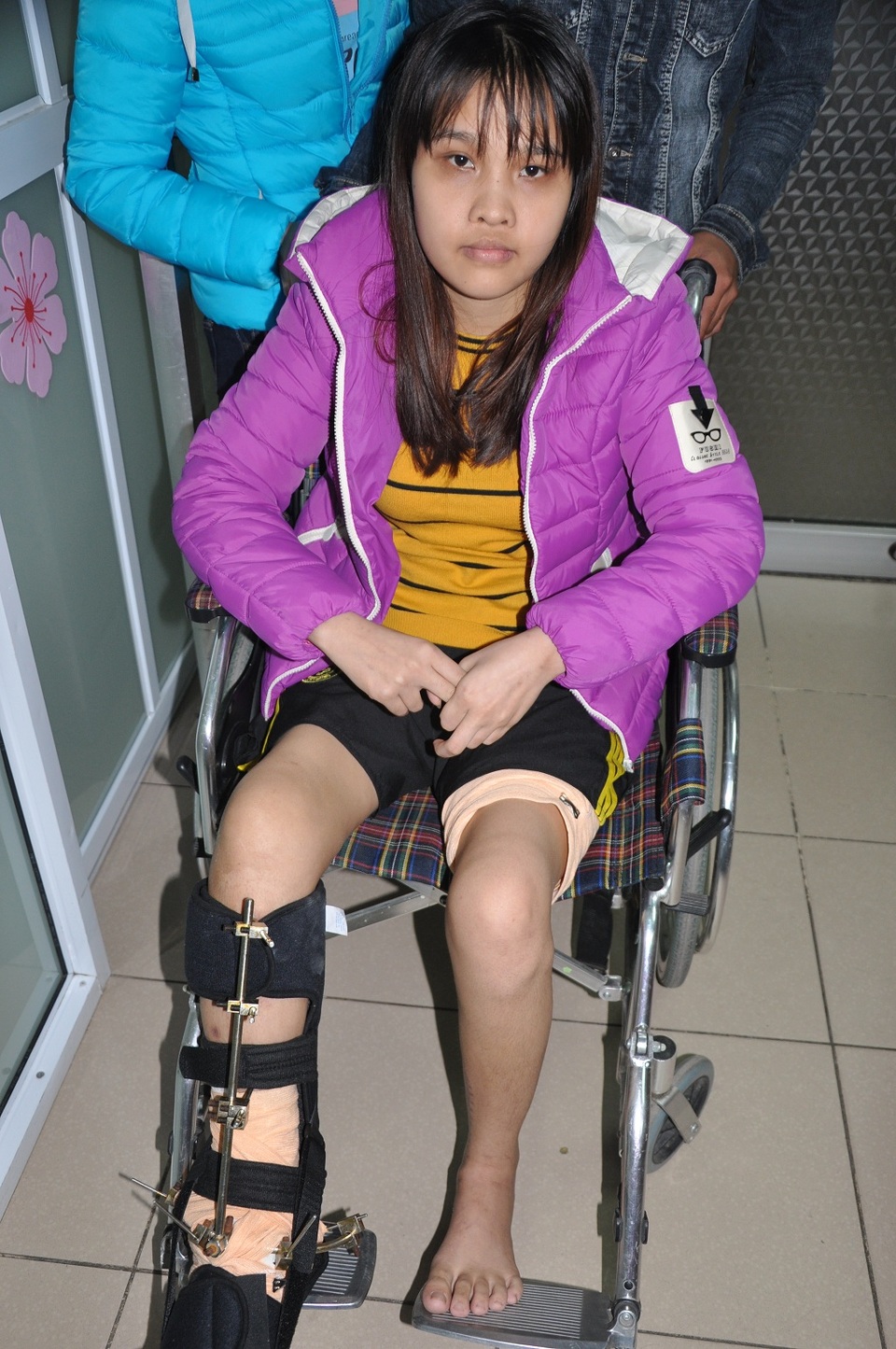 Trao gần 56 triệu đồng đến nữ sinh có nguy cơ cắt bỏ chân vì tai nạn - 1 Phía chân bị tổn thương của Nhung đã giữ lại được nhờ các bác sĩ BV ĐH Y Hà Nội.