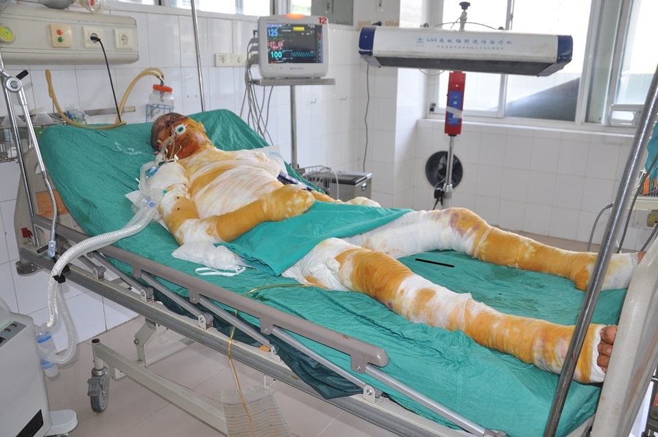 Vợ nghèo đau đớn cùng lúc nhận tin chồng ung thư, con bị bỏng nặng - 1 Em Phong bị bỏng khi đang làm hàn xì nên phải chuyển lên cấp cứu tại Viện bỏng quốc gia.