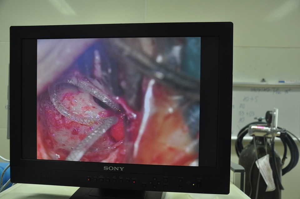 Ca mổ cấy điện cực ốc tai cho bé Như Quỳnh đã thành công - 4 Hình ảnh điện cực ốc tai được cấy cho bé Như Quỳnh.