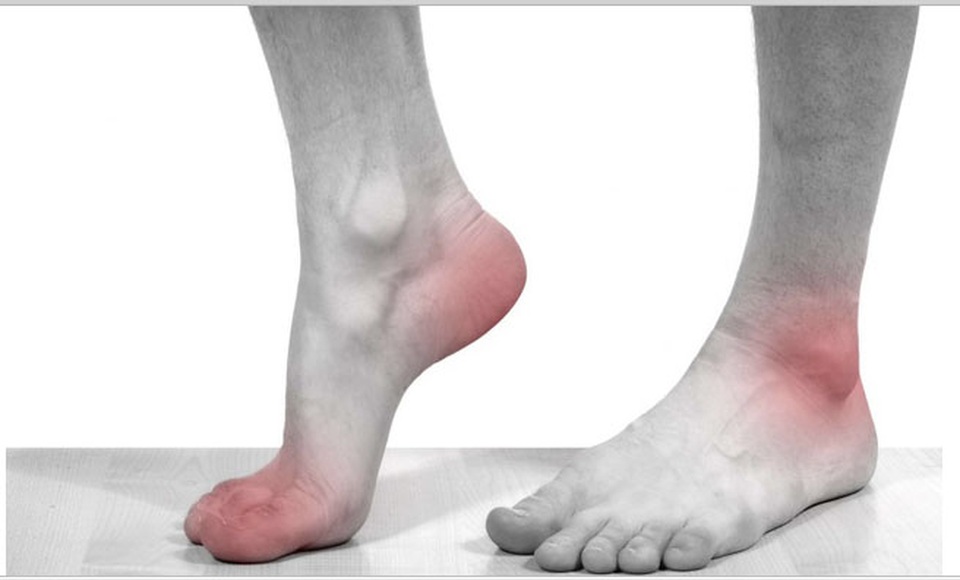 Phần lớn người bệnh bị gút mạn tính nhưng không biết - 1
Cơn đau gút liên tục tái diễn chính là gút mạn tính