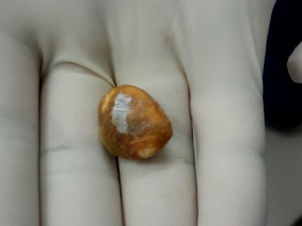 Hạt măng cụt trong dạ dày bệnh nhân nữ sắp nảy mầm