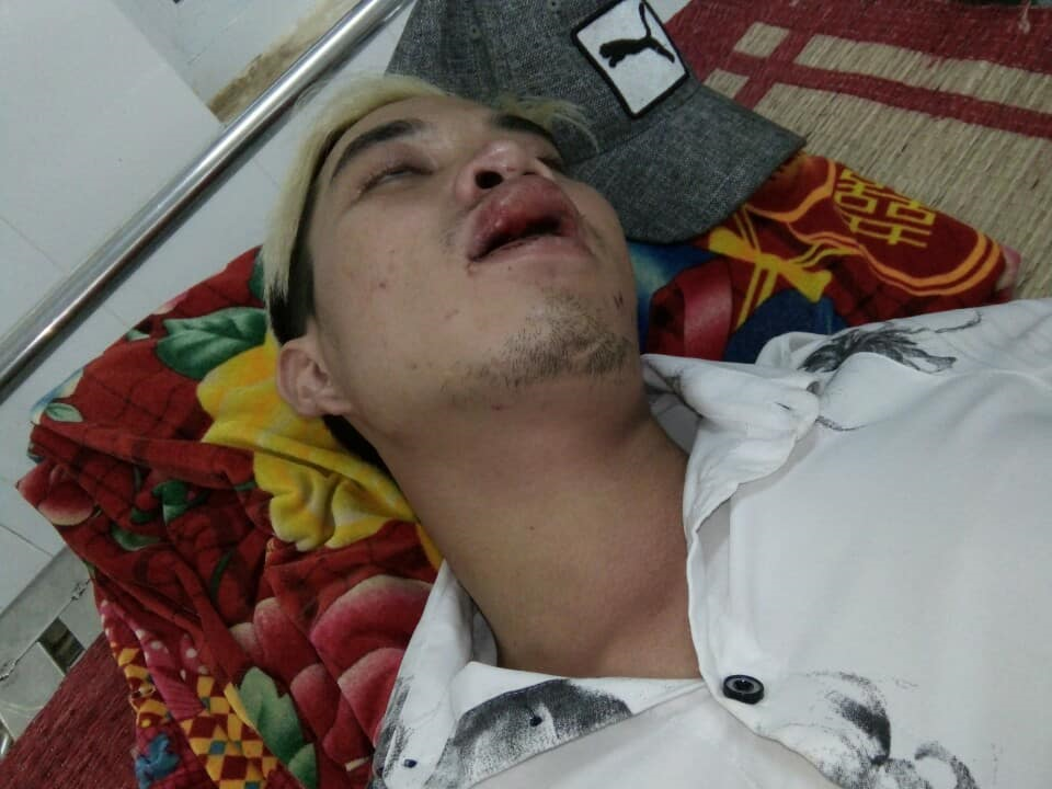 Anh Ngọn nhập viện cấp cứu do tự tông vào xe CSGT