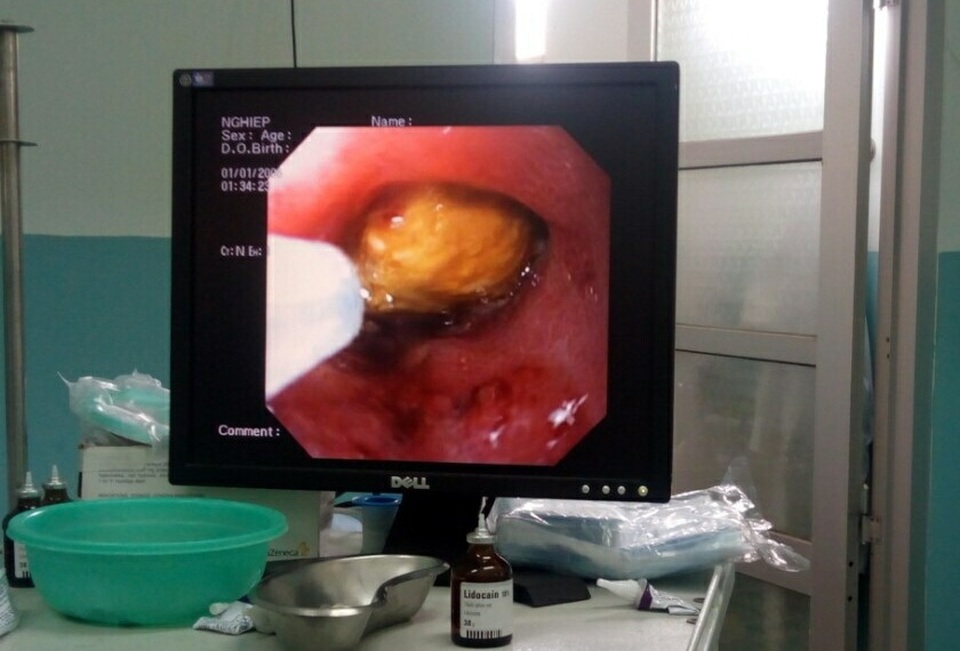 Hình ảnh siêu âm phát hiện hạt măng cụt trong dạ dày bệnh nhân nữ